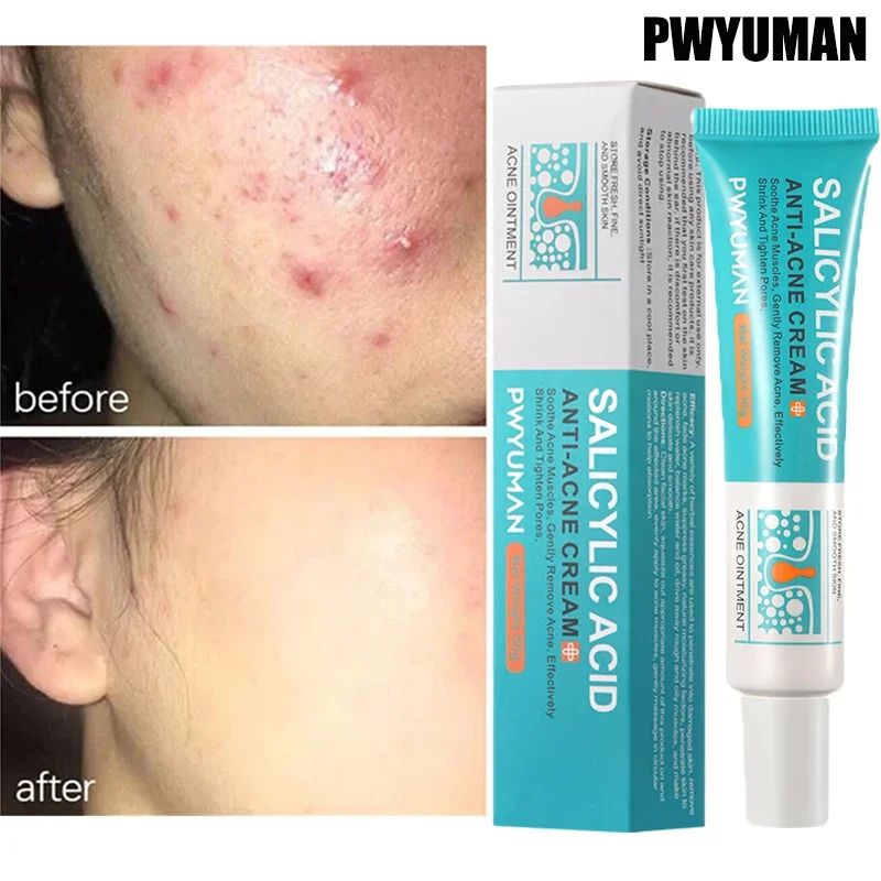 

Salicylic Acid Acne Removal Cream Repair Pimple Spots Deep Cleaning Pore Shrinking Anti-acne Oil Control Moisturizing Skin Care