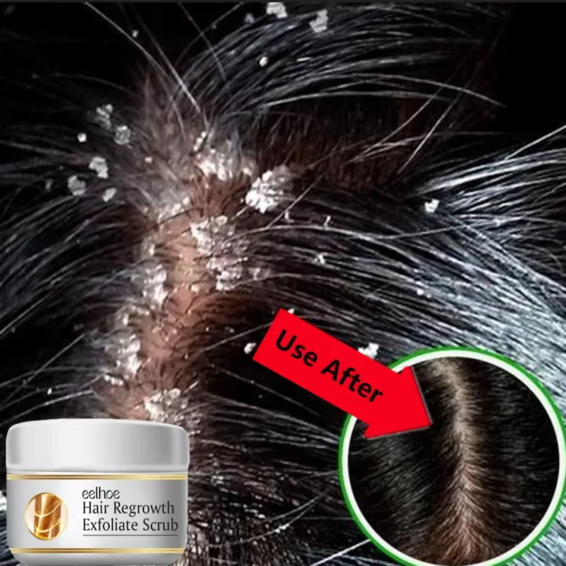 Scalp Treatment Fast Anti Exfoliating Scrub Remove Dandruff Anti Itching Seborrheic Scalp Oil Control Repair Scalp Beauty Health Care