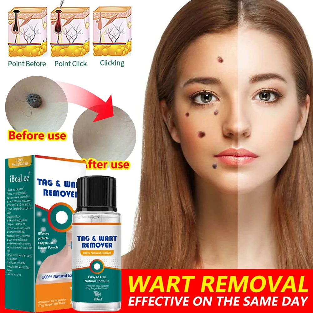 

Face Wart Tag Treatment Essential Skin Tag Remover Serum Painless Solutions Mole Skin Stain Removal Wart Professional Liquid