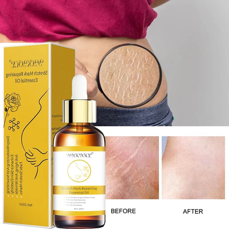 

Stretch Marks Remover Essential Oil Skin Care Treatment Cream For Stretch Mark Removal Maternity Slackline For Pregnant Oils