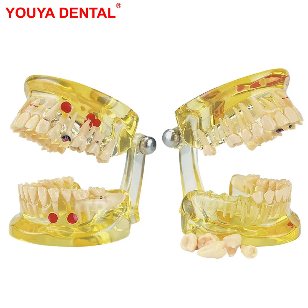 Dental Teeth Model With Removal Teeth Dental Models For Patient