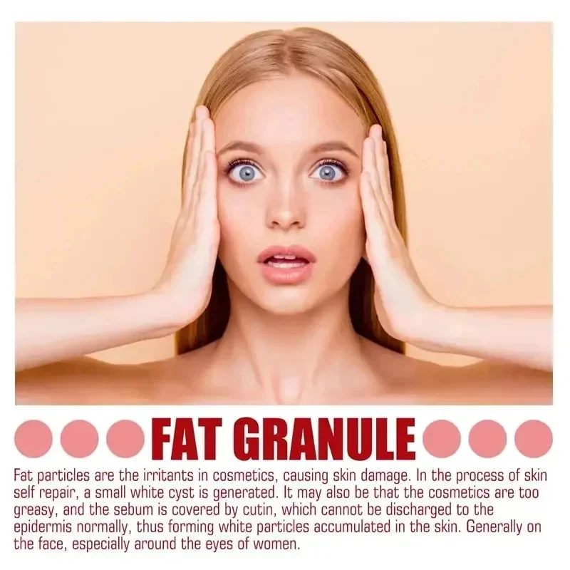 Eye Cream for Fat Granules Puffiness - Milia Remover Skin Repair