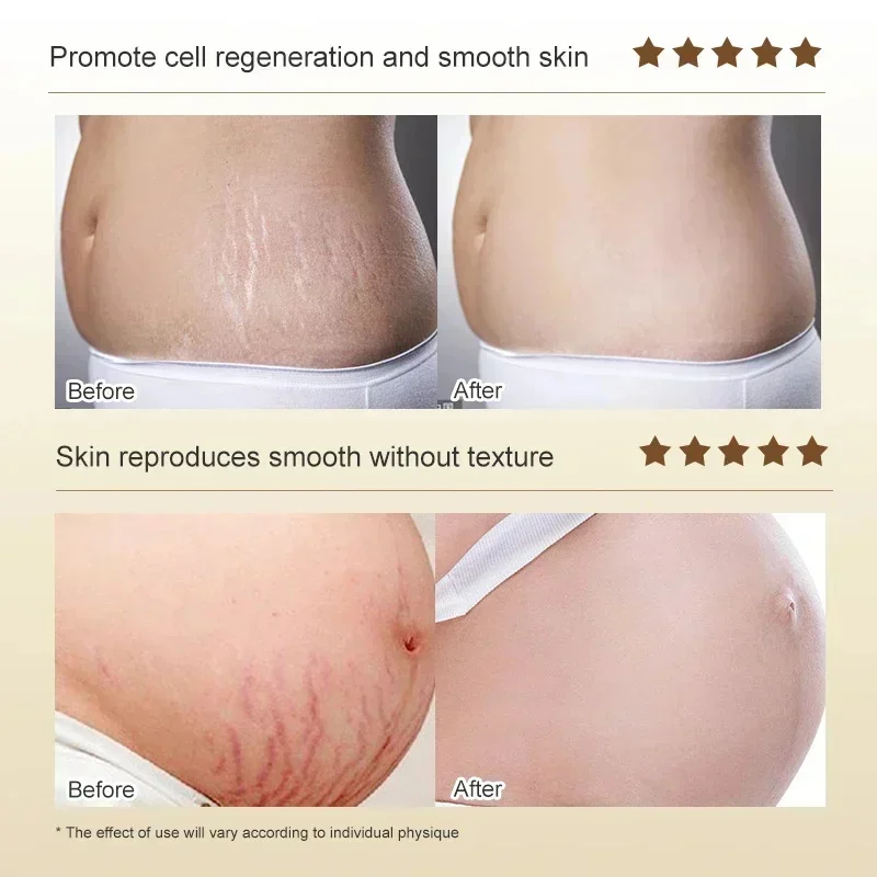 Removes Stretch Mark Cream To Remove Postpartum Obesity Pregnant Women Repair Anti-Aging Winkles Firming Body Cream Skin Care