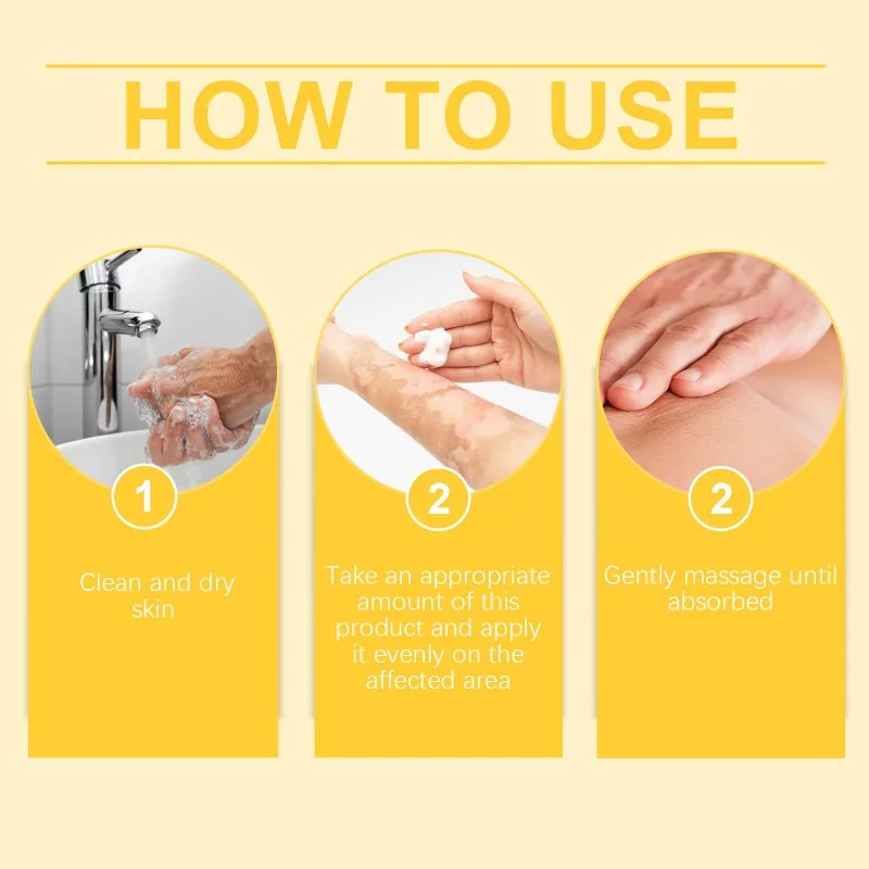 Bee Venom Vitiligo Treatment Cream Eliminate Vitiligo Sweat Spot Antibacterial Mycosis Leukoplakia Cure Moisturizes Care Cream vitiligo ointment