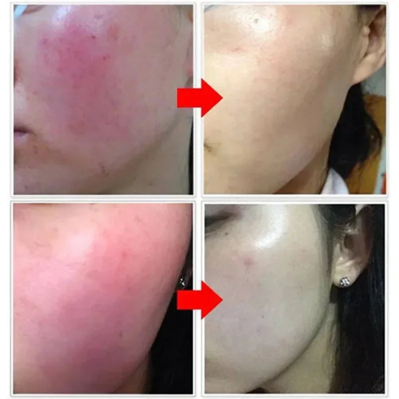 7 Day Repair Redness Serum Sooth Itching Sensitive Skin Improve Rosacea Shrink Pore Smooth Nourish Facial Skin Korean Cosmetics 2