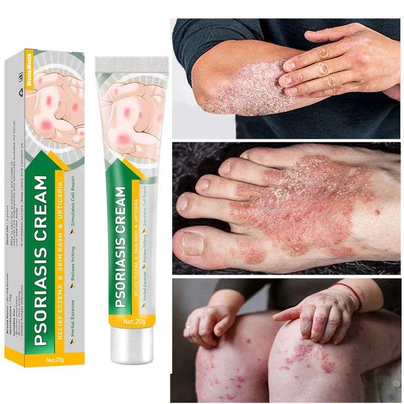 Herbal Eczema Psoriasis Spray Antibacterial Dermatitis Athletes Foot