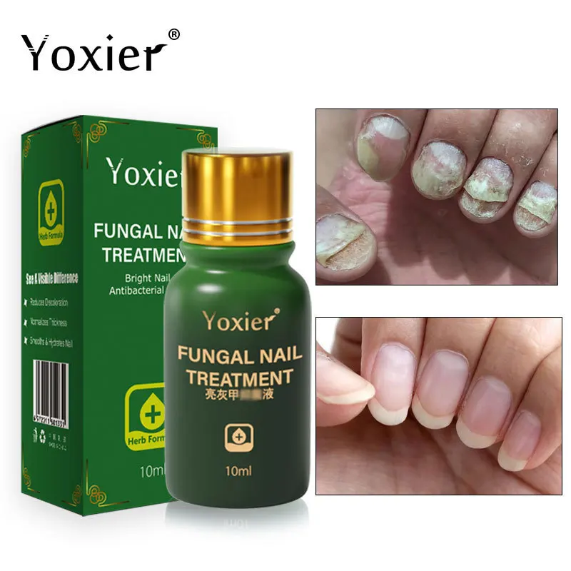 

Fungal Nail Treatment Serum Repair Thickening Atrophy Yellowing Shedding Nourish Anti Infection Herbal Formula Nail Care Product