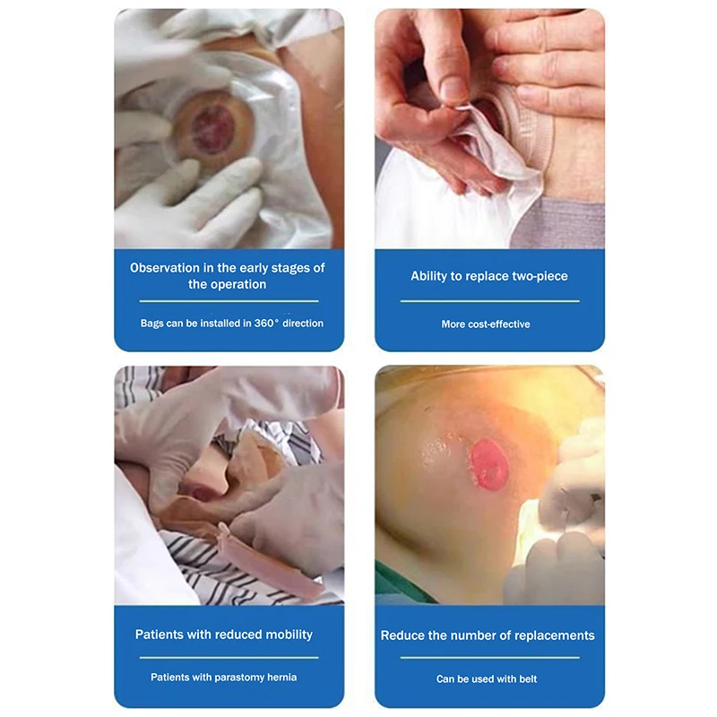 Disposable Ostomy Bags Skin Stoma Rings Leakproof Barriers Baseplates Built In Activated Carbon Sheet Lining Safe Daily Use Fits