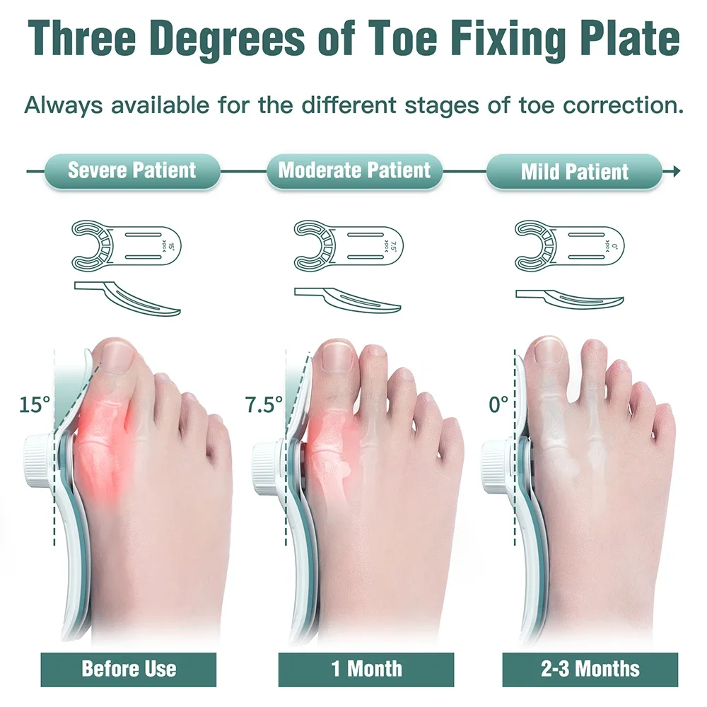 New Bunion Corrector Hallux Valgus Orthotics Big Toe Homing Straightener Adjustable Knobs With 3 Angle Fixing Plate Foot Care