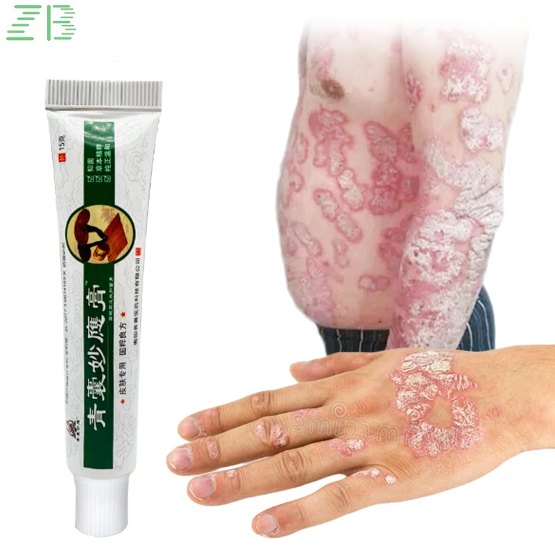 

Professional Treatment Psoriasis Ointment Medicine Plaster Chinese Herbal Antibacterial Anti-Itch Eczematoid Urticaria Cream