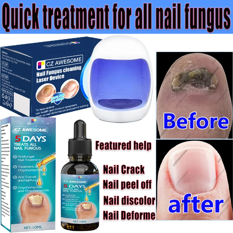 Fungal Nail Laser Device Repair Fast  Nails Fungus Onychomycosis