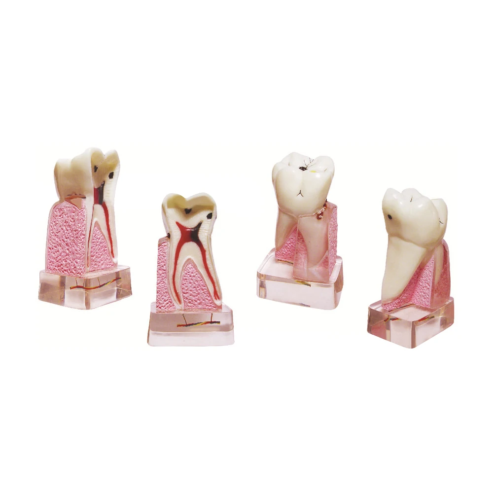 치과 병리학 모형, 4배 확대된 해부학적 치아 모형, 친환경 PVC, 의료 교육용품, 실험실 도구