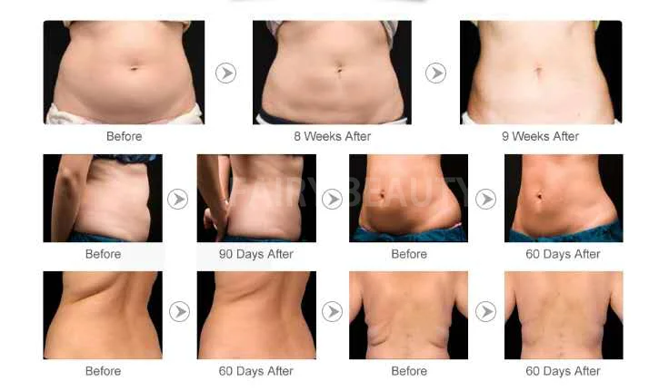 Neues Ultraschall 4 in 1 Kavitation Schlankheit gerät Vakuum massage gerät zur Reduzierung von Cellulite Gewichts verlust Körperform ung Fett absaugung – Detail 9