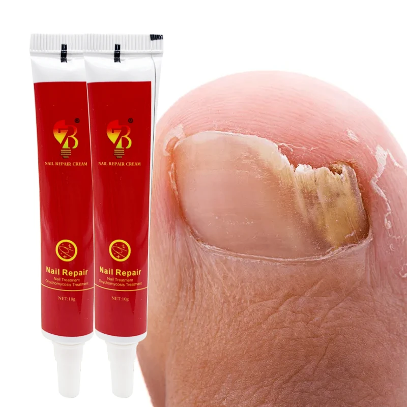 Nail Fungal Treatment Cream Onychomycosis Paronychia Anti Infection Toe Fungus Hand Foot Removal