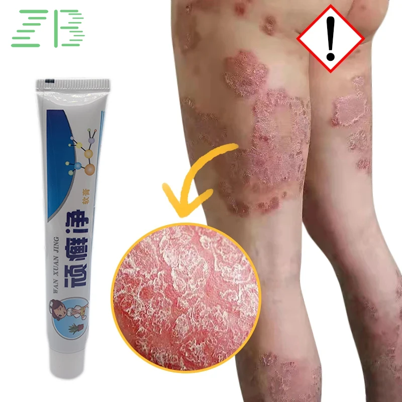 

25g Skin Psoriasis Cream 100% Original Herbal Plaster Dermatitis Eczematoid Eczema Ointment Treatment Psoriasis Skin Care Cream