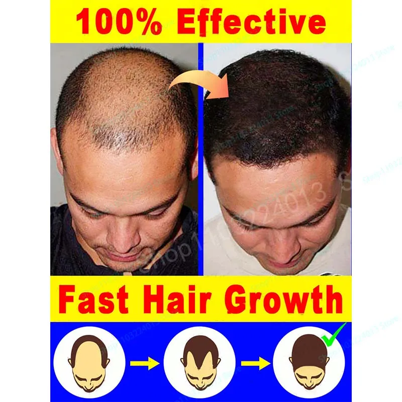 Unisex Hair Growth Oil Hair Loss Treatment Rapid Hair Growth Effective Baldness Repair Hereditary Postpartum Hair Loss