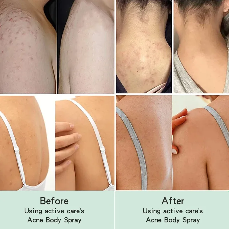 Whitening Cream Back Acne Repair Spray Acne Removal Essence Oil Oil Butt Shoulder Care Cream Control Back Whitening Moisturize Removal Spray