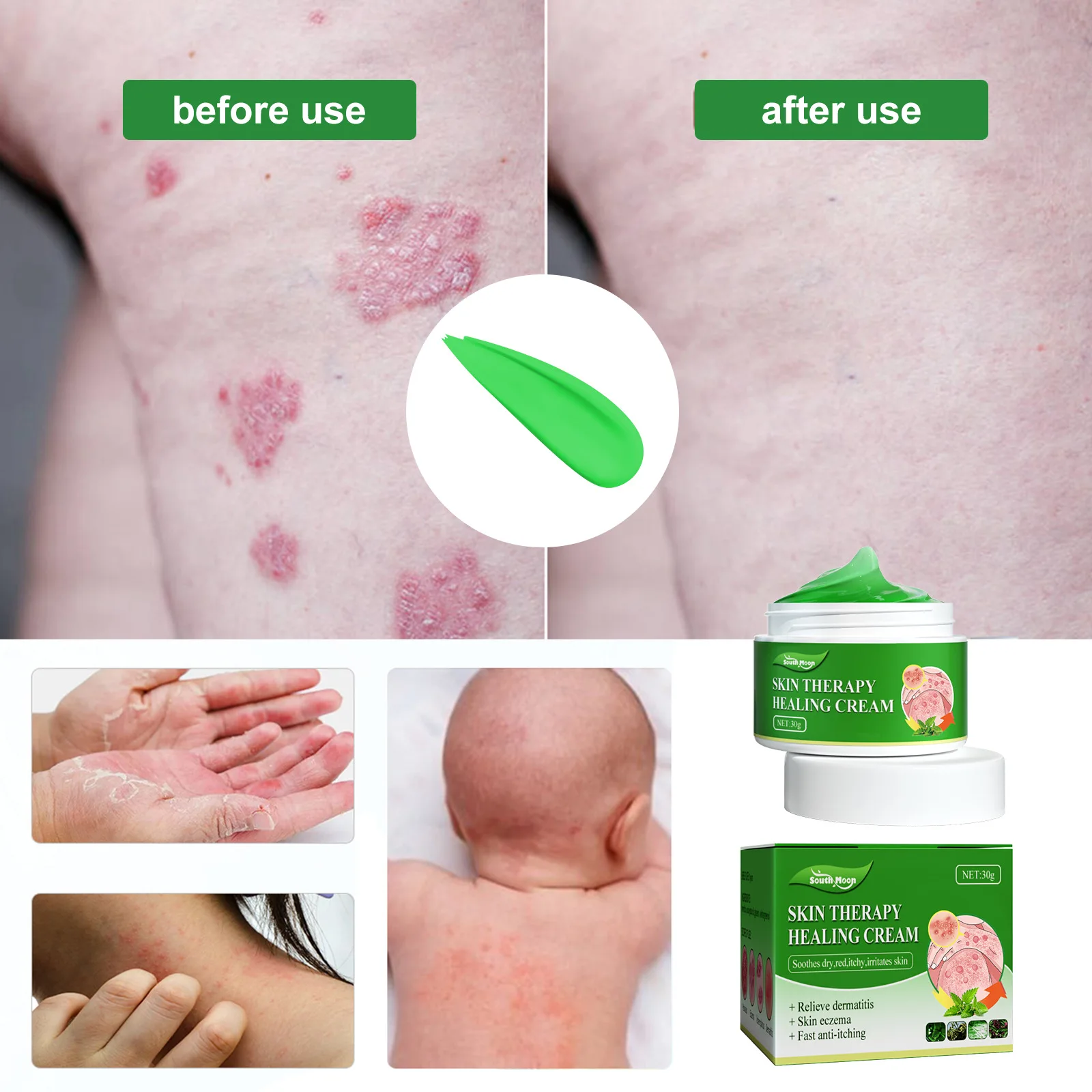 South Moon Eczema Treatment Cream Anti Itching Remove Psoriasis Dermatitis Eczematoid Repair Skin Care Antibacterial Ointment