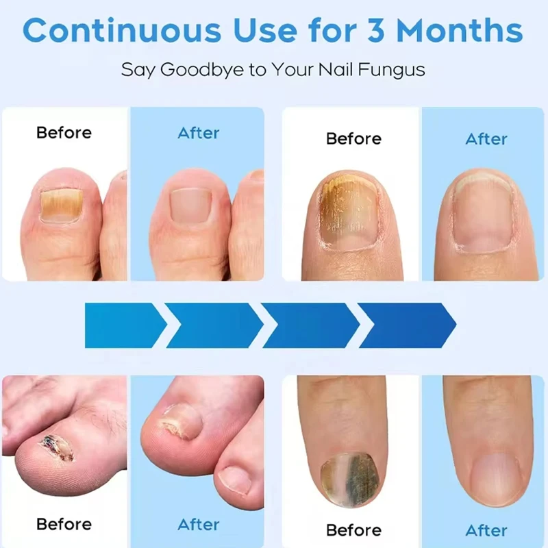 Semi-arc Nail Fungus Laser Device Cure Onychomycosis Toenail Fingernail Fungal Therapy Time display nail fungus remover,laser therapy pen