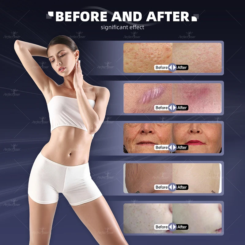 Рисунок 2 - Фракционный аппарат CO2 для восстановления кожи лица