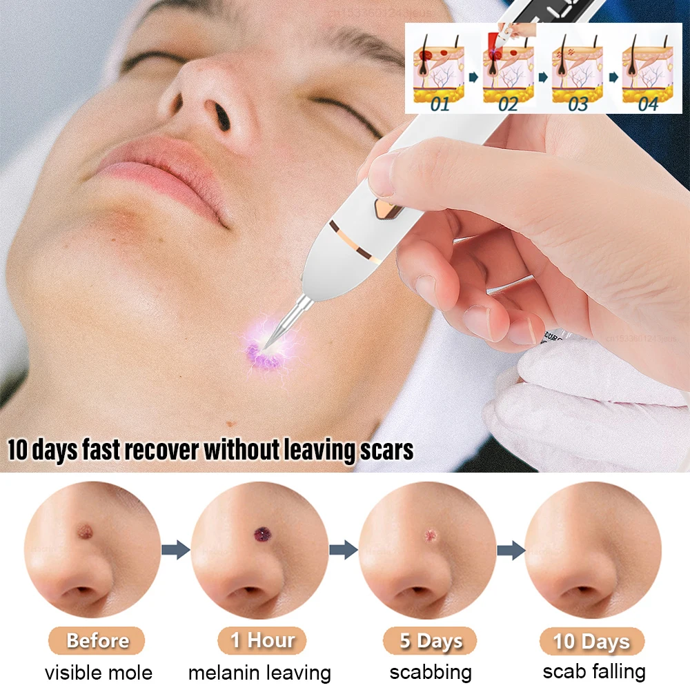 Laser Plasma Pen Remover for Warts Moles Skin Tags Freckles Papilloma Nevus Dark Spots