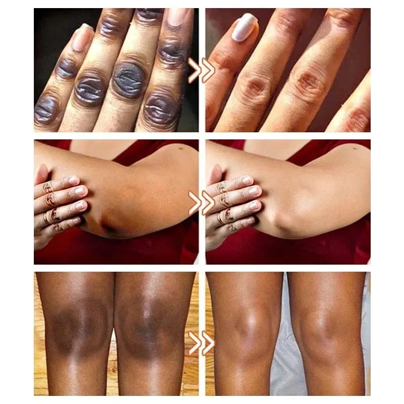 Brightening Private Parts Cream Knuckles Underarm Bleaching Cream Butt Knee Brighten Emulsion Inner Thigh Armpit Remove Melanin 5