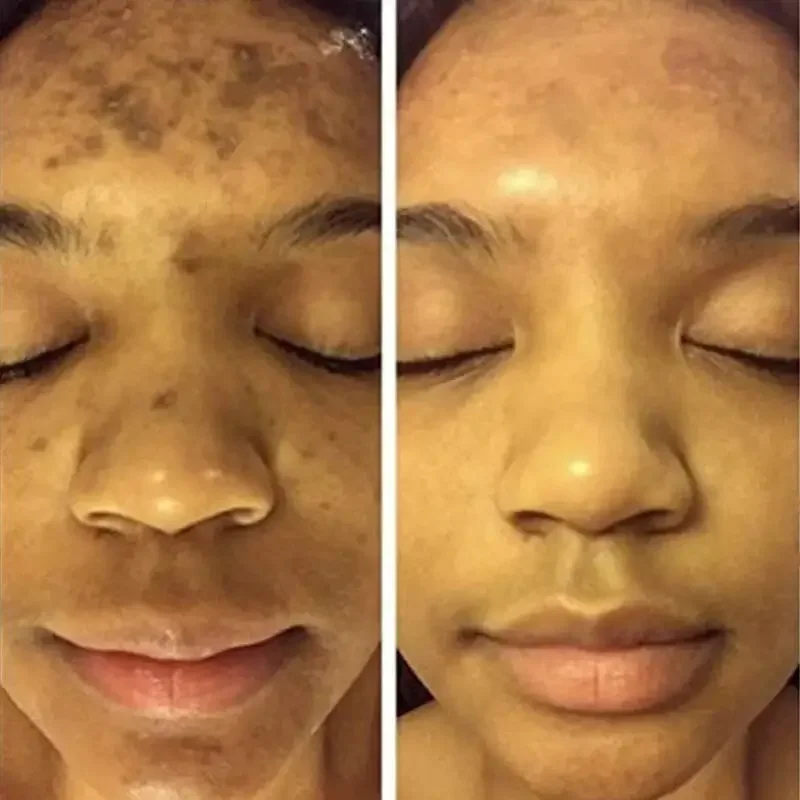 O açafrão que alvejante o soro facial, sardas, remove pontos escuros, melasma ilumina, melanina, cicatriz da acne, antienvelhecimento, firme ilumina