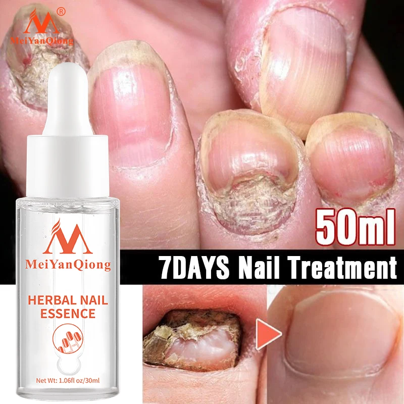 

3pcs New!!! Fungal Nail Treatment Essence Nail And Foot Whitening Toe Nail Fungus Removal Feet Care Nail Gel