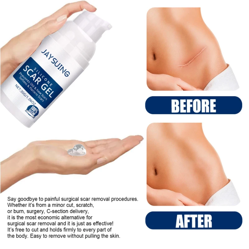 Silicone Scar Removal Cream Gel Burn Surgical Scar Cesarean Repairing Stretch Marks Whitening Pigmentation Corrector