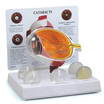 Human Cataract Eye Anatomical Model – Anatomy Replica of Normal Eye Educational Medical Tool for Doctor’s Office 1