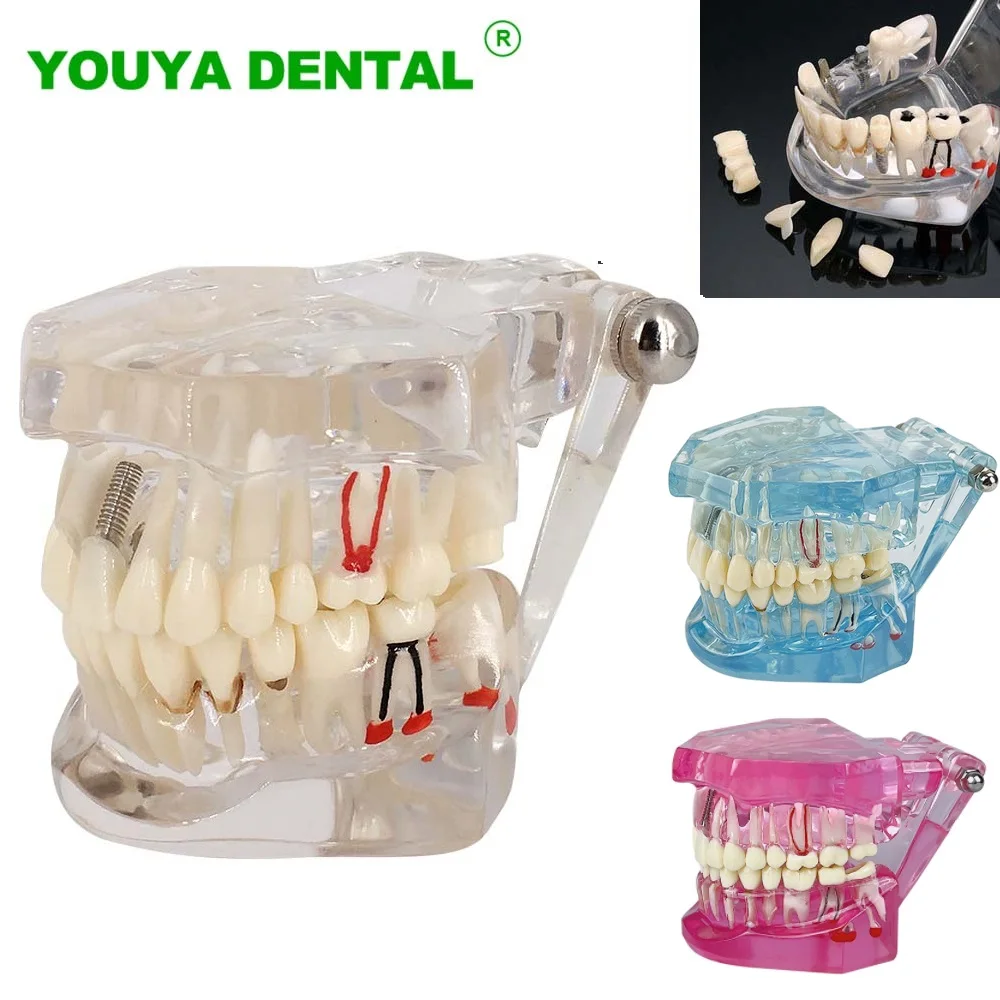 

Dental Model Teeth Implant Restoration Bridge Model Removable Tooth Teaching Study Medical Science Disease Dentistry Products