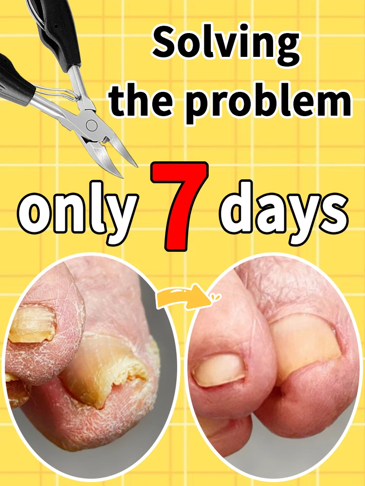 Ingrown nail nippers, toenail clippers, deep nail groove manicure tools, help essential oil absorption, solve problems