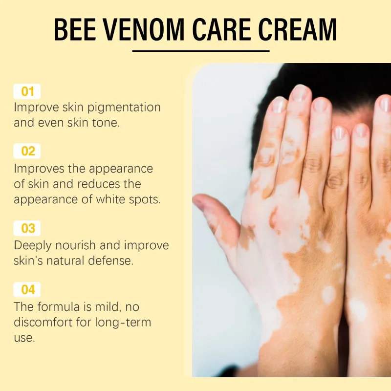 Bee Venom Vitiligo Treatment Cream Natural Relief Skin Treatment Soothing White Spot Removal Vitiligo Ointment Eliminate Pigment pain ointment gel