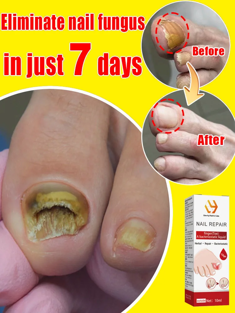 Nail Fungus Problem Solution,fungus solution