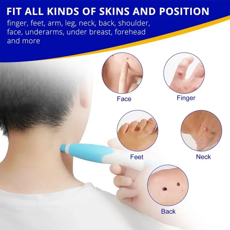 Skin Tag Remover Pen 5