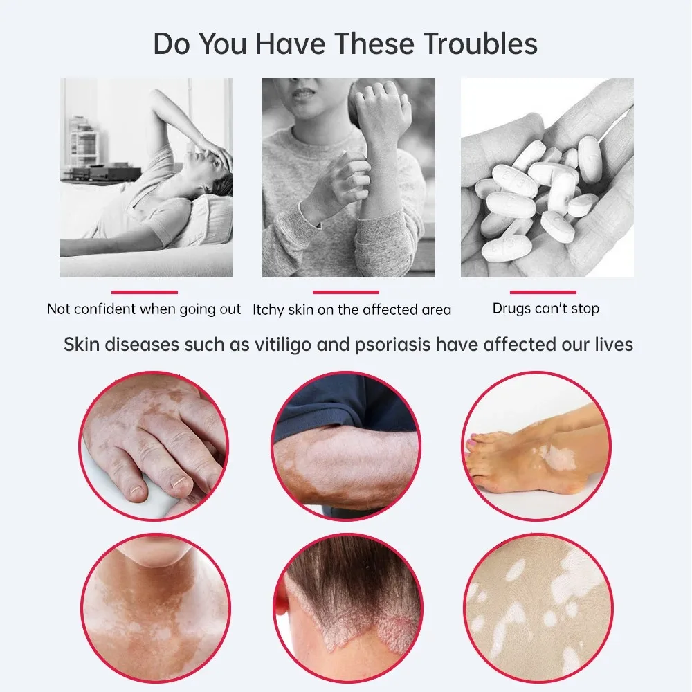 UVB Lamp UV for Vitiligo Psoriasis White Spots Skin Disease 311nm Ultraviolet Phototherapy Instrument - Image 5