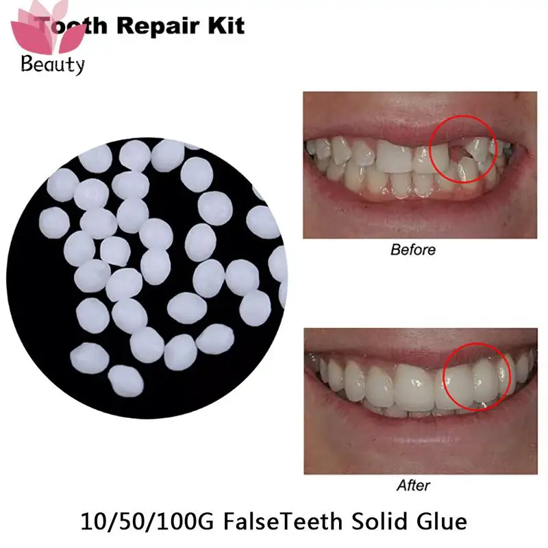 10/20/30ml Temporary Tooth Repair Kit Teeth And Gaps Falseteeth Solid Glue  Denture Adhesive Teeth Whitening Tooth Beauty Tool - Denture Care Products  - AliExpress