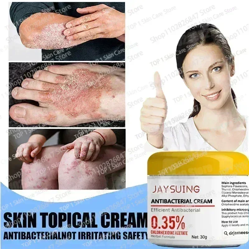 Psoriasis Antibacterial Anti-itch Dermatiti Eczema Urticaria Alergy Skin Beauty Health Body Care