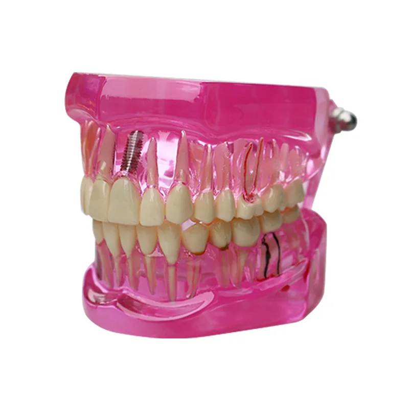 탈착식 치과 임플란트 복원 교육 모델, 의사-환자 의사소통 시뮬레이션 의료 교육 도구