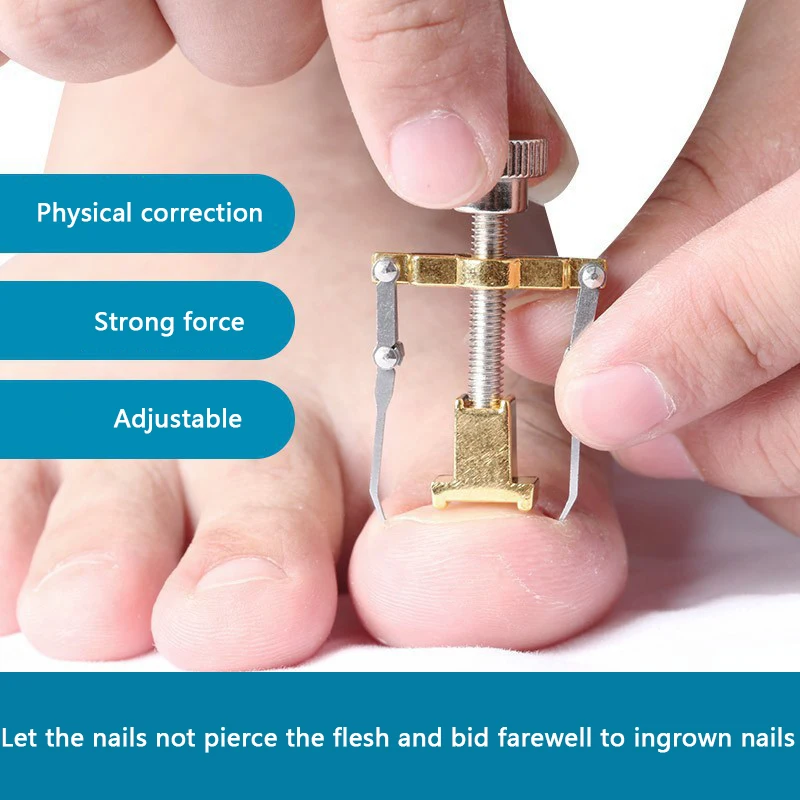 

Уход за ногами ортопедическое лечение корректор для вросших ног 2023