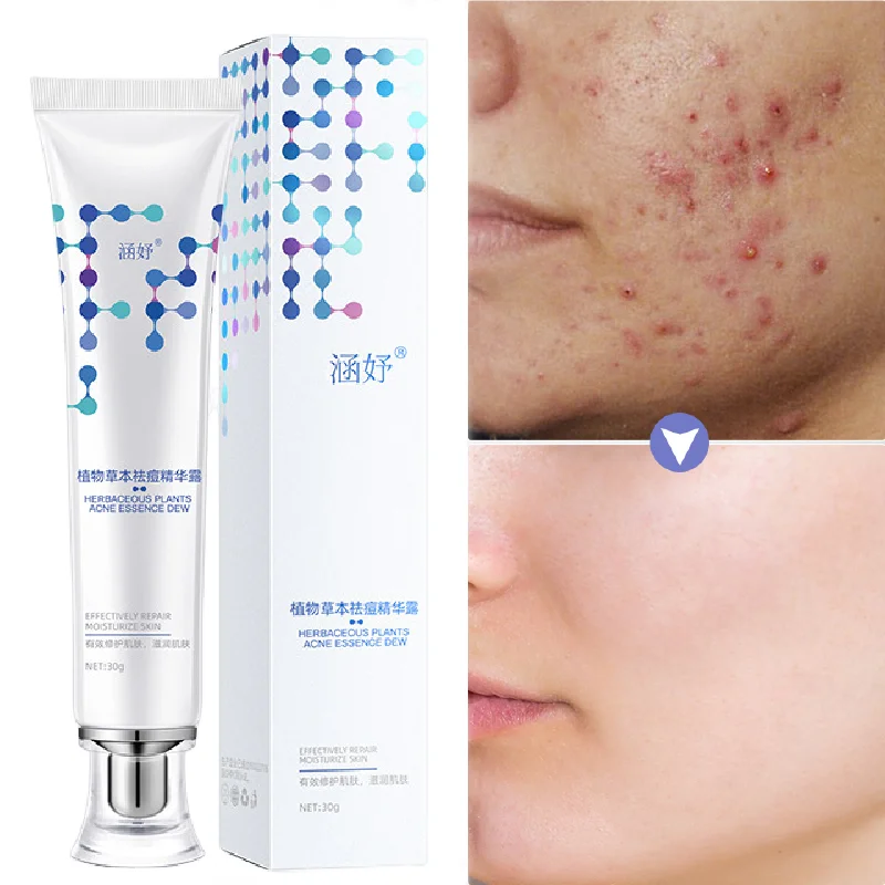 

Herbal Acne Cream Effective Pimple Treatment Anti-inflammatory Pore Shrinkage Purifying Gel Botanic Repair Oil Control Skin Care