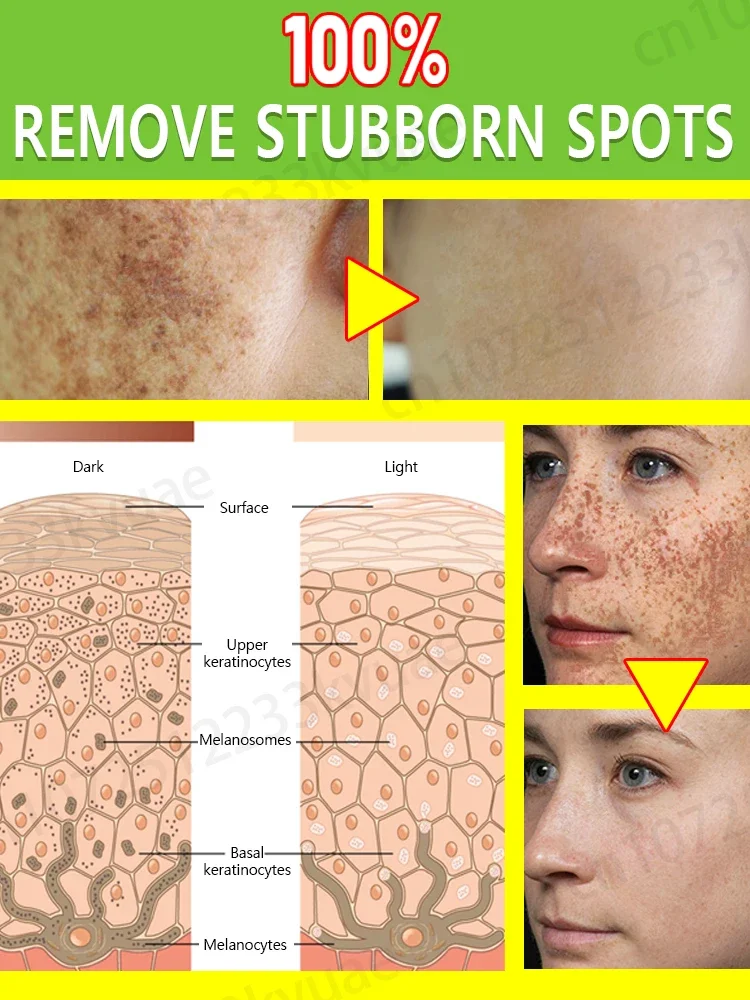 Anti-freckle essence, effectively removes dark spots, age spots, chloasma and freckles in 7 days 4