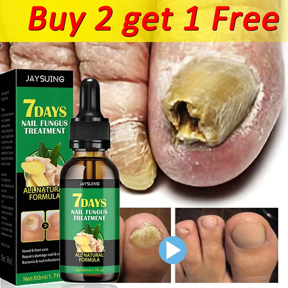 Fungal Nail Treatment Essence Oil Nail Fungus Laser Device Repair Toenail Fingernail Ginger Treatment Hand Foot Essence Liquid