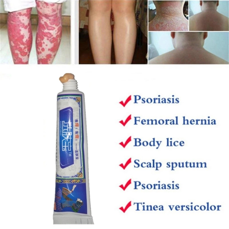 Antibacterial Psoriasis Cream Herbal Effective Anti-itch Relief Dermatitis Eczema Treatment Urticaria Desquamation Skin Care