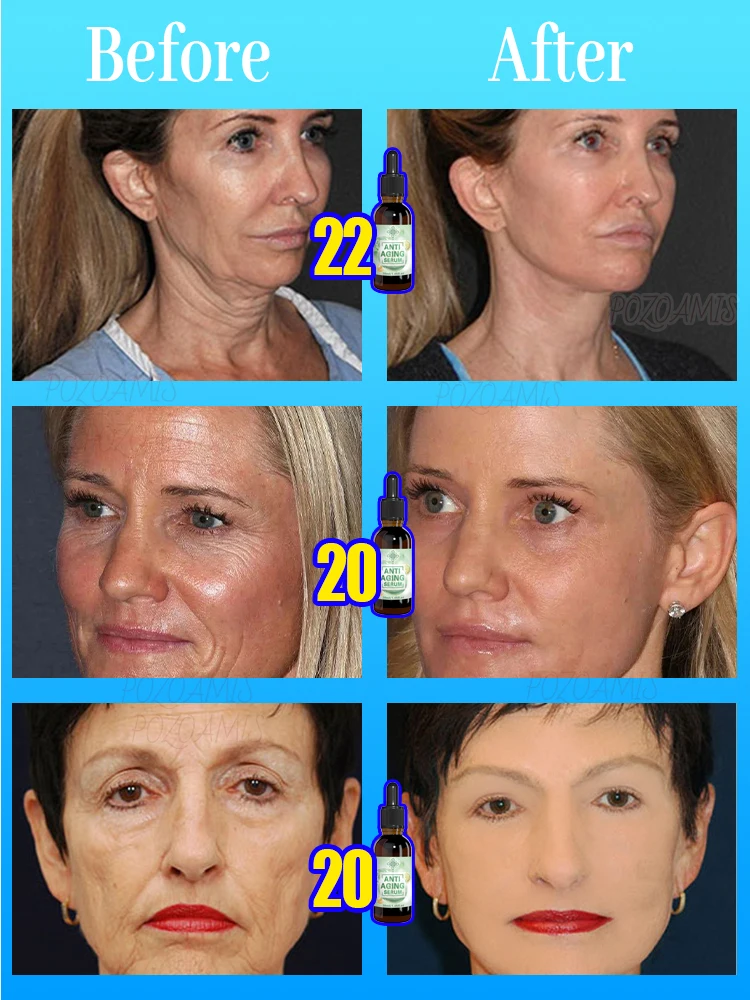 wrinkles disappear 100% younger 5