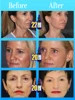 wrinkles disappear 100% younger 5