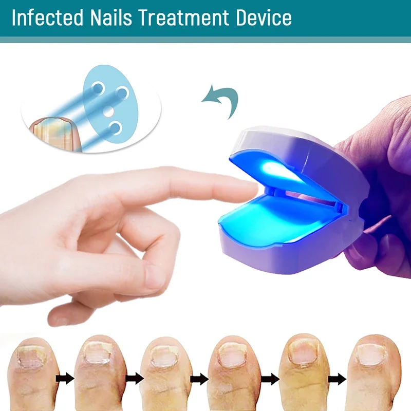905NM Nail Fungus Laser Nail Treatments Device Light Therapy USB Charging for Fingernails and Toenails Onychomycosis Cure Tools