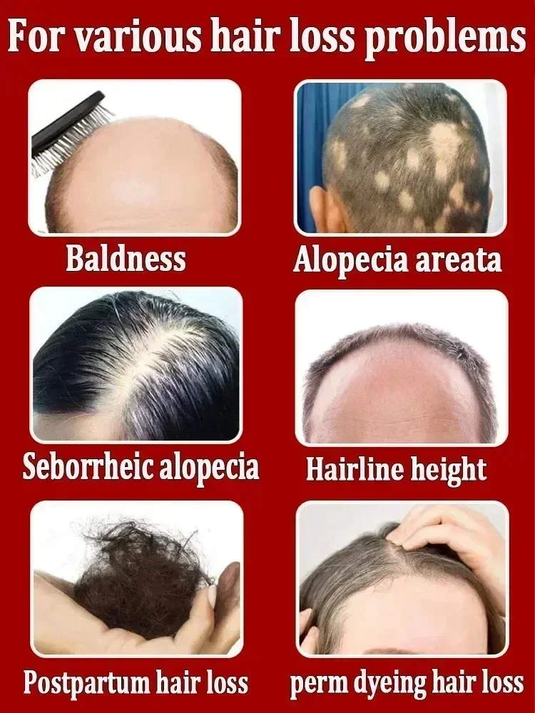 Produtos bem sucedidos,99% dos compradores comprar&atilde;o novamente,eles t&ecirc;m mais e mais cabelo, digamos calv&iacute;cie alfa, cabelo grosso