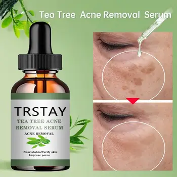 Acne Treatment Face Serum Tea Tree Oil Essence Moisturizing Shrink Pores Acne Facial Serum Korean Skin Care Products 2