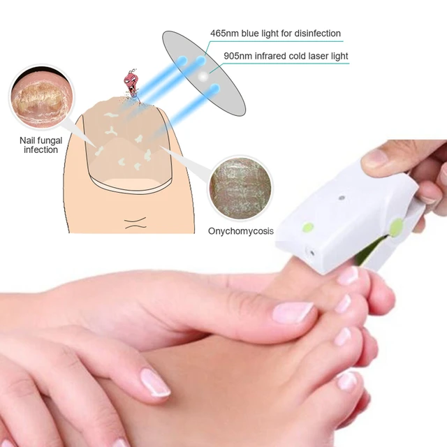 Kisshi™ High-Efficiency Nail Fungus Cold Light Therapy Device –  Cozyphilosophy
